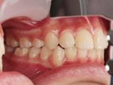 上顎前突症（出っ歯）　治療後