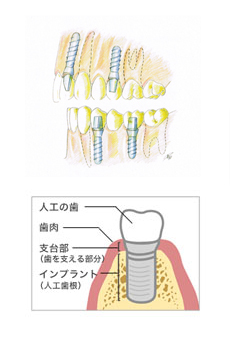 インプラントとは?